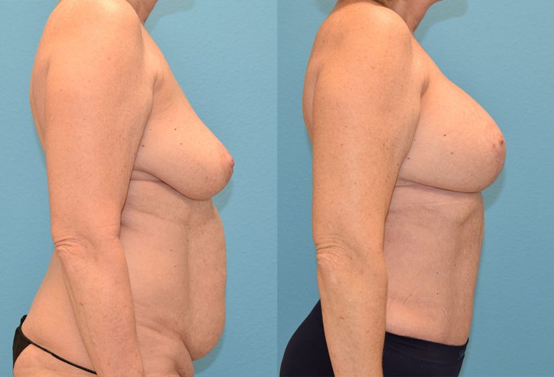 Mommy Makeover results by Dr. Maningas at Maningas Cosmetic Surgery in Joplin, MO