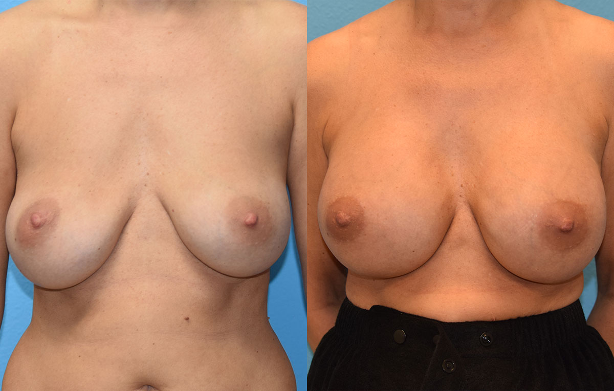 Breast implant exchange with a pocket transition from above to below the muscle. Result by Dr. Maningas, triple board certified cosmetic surgeon in Joplin, MO