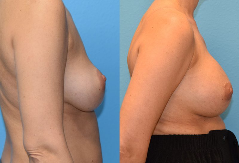 Breast implant exchange with a pocket transition from above to below the muscle. Result by Dr. Maningas, triple board certified cosmetic surgeon in Joplin, MO