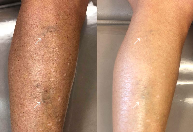 Sclerotherapy, or sider vein treatment, in Joplin, MO at Maningas Cosmetic Surgery to permanently remove small to medium sized leg spider veins