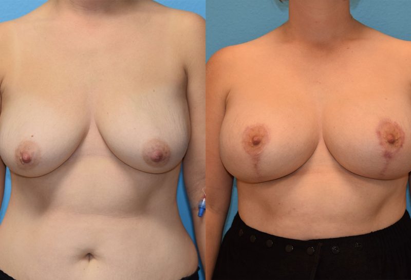 Breast Lift with Implants results by Dr. Maningas as Maningas Cosmetic Surgery