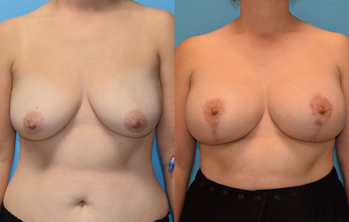 Breast Lift with Implants results by Dr. Maningas as Maningas Cosmetic Surgery