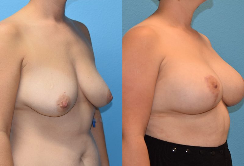 Breast Lift with Implants results by Dr. Maningas as Maningas Cosmetic Surgery