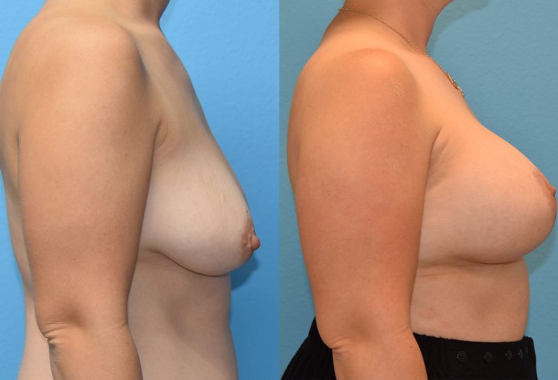 Breast Lift with Implants results by Dr. Maningas as Maningas Cosmetic Surgery