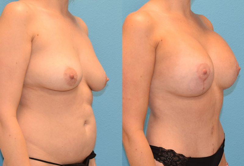 Breast Lift with Implants results by Dr. Maningas as Maningas Cosmetic Surgery