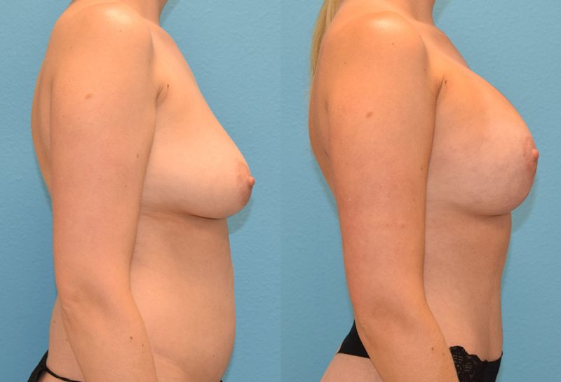 Breast Lift with Implants results by Dr. Maningas as Maningas Cosmetic Surgery