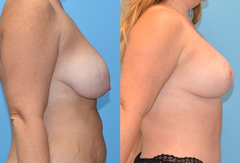 Breast Lift with Implants results by Dr. Maningas as Maningas Cosmetic Surgery