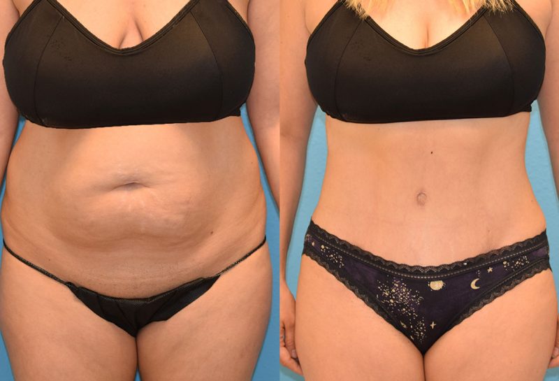 Tummy tuck results by Dr. Maningas at Maningas Cosmetic Surgery in Joplin, MO