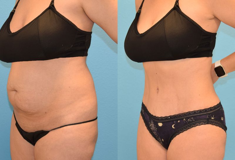 Tummy tuck results by Dr. Maningas at Maningas Cosmetic Surgery in Joplin, MO