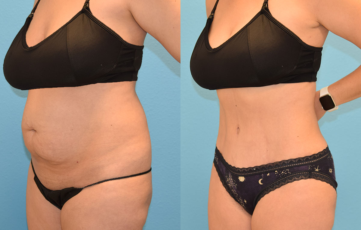 Tummy tuck results by Dr. Maningas at Maningas Cosmetic Surgery in Joplin, MO