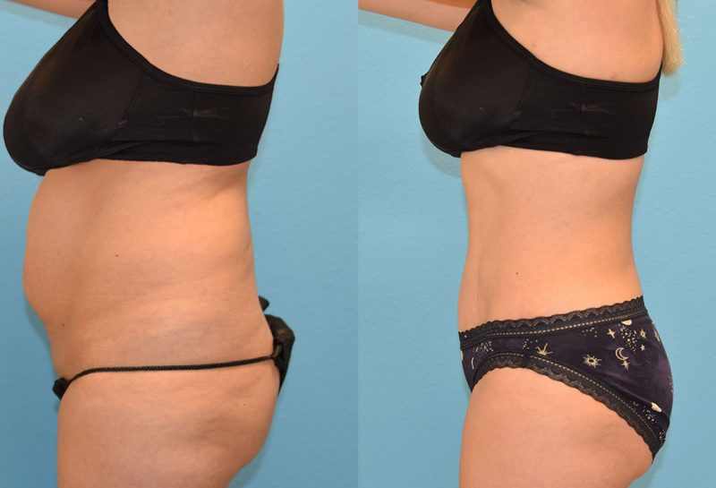 Tummy tuck results by Dr. Maningas at Maningas Cosmetic Surgery in Joplin, MO