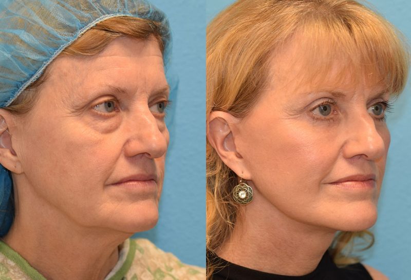 Facelift, Eyelid Surgery and CO2 laser results at Maningas Cosmetic Surgery in Joplin, MO and Northwest Arkansas