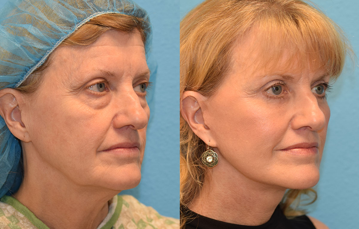 Facelift, Eyelid Surgery and CO2 laser results at Maningas Cosmetic Surgery in Joplin, MO and Northwest Arkansas