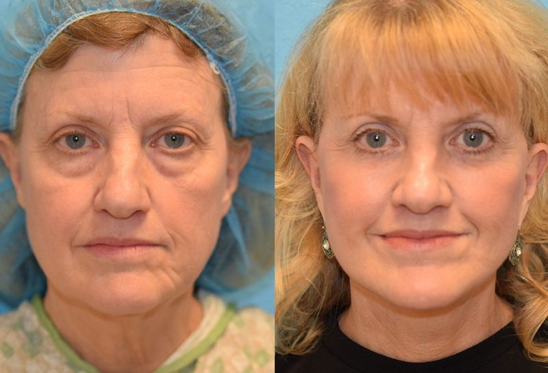 Facelift, Eyelid Surgery and CO2 laser results at Maningas Cosmetic Surgery in Joplin, MO and Northwest Arkansas