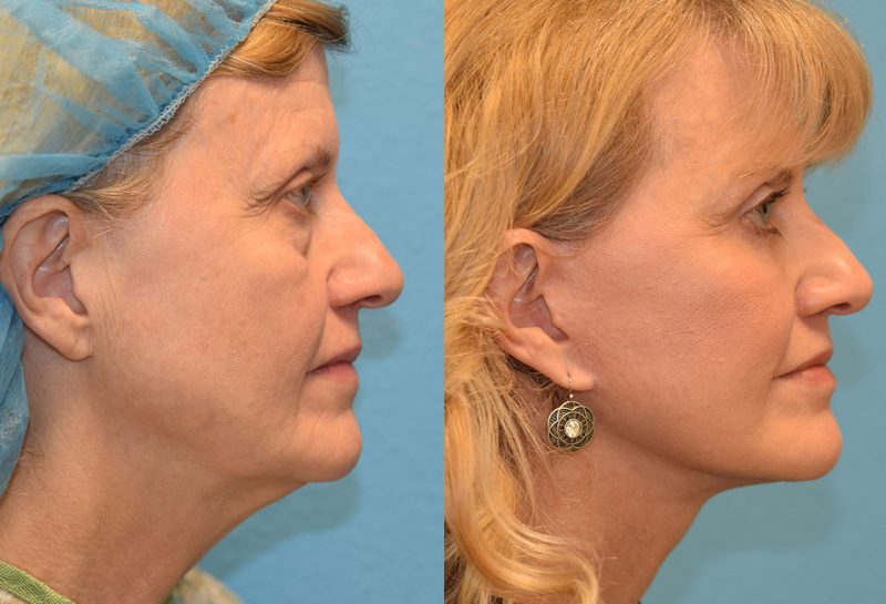 Facelift, Eyelid Surgery and CO2 laser results at Maningas Cosmetic Surgery in Joplin, MO and Northwest Arkansas