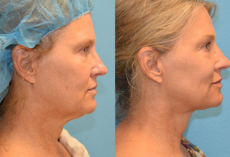 Non-surgical lower blepharoplasty and mini facelift with accutite and Facetite. Minimally invasive procedure by Dr. Maningas in Joplin, MO