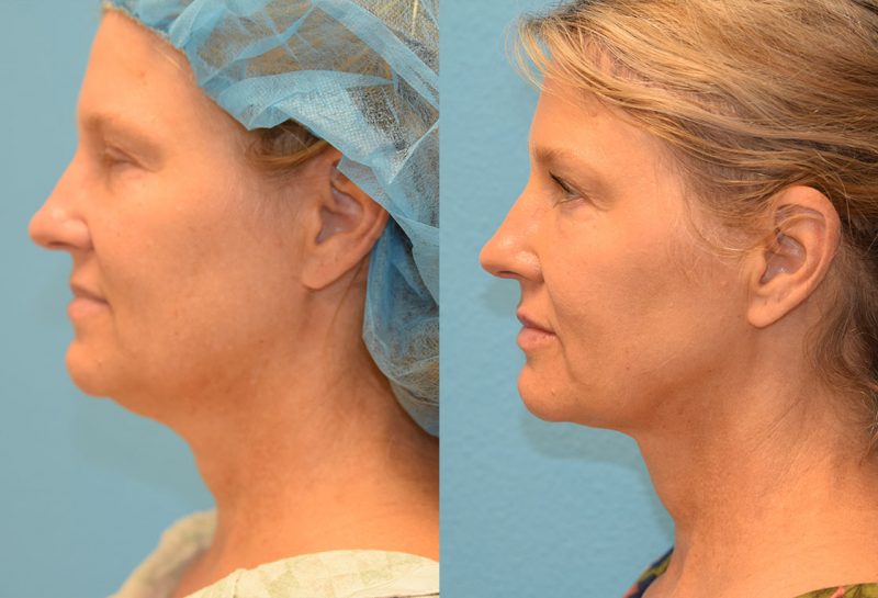 Non-surgical lower blepharoplasty and mini facelift with accutite and Facetite. Minimally invasive procedure by Dr. Maningas in Joplin, MO