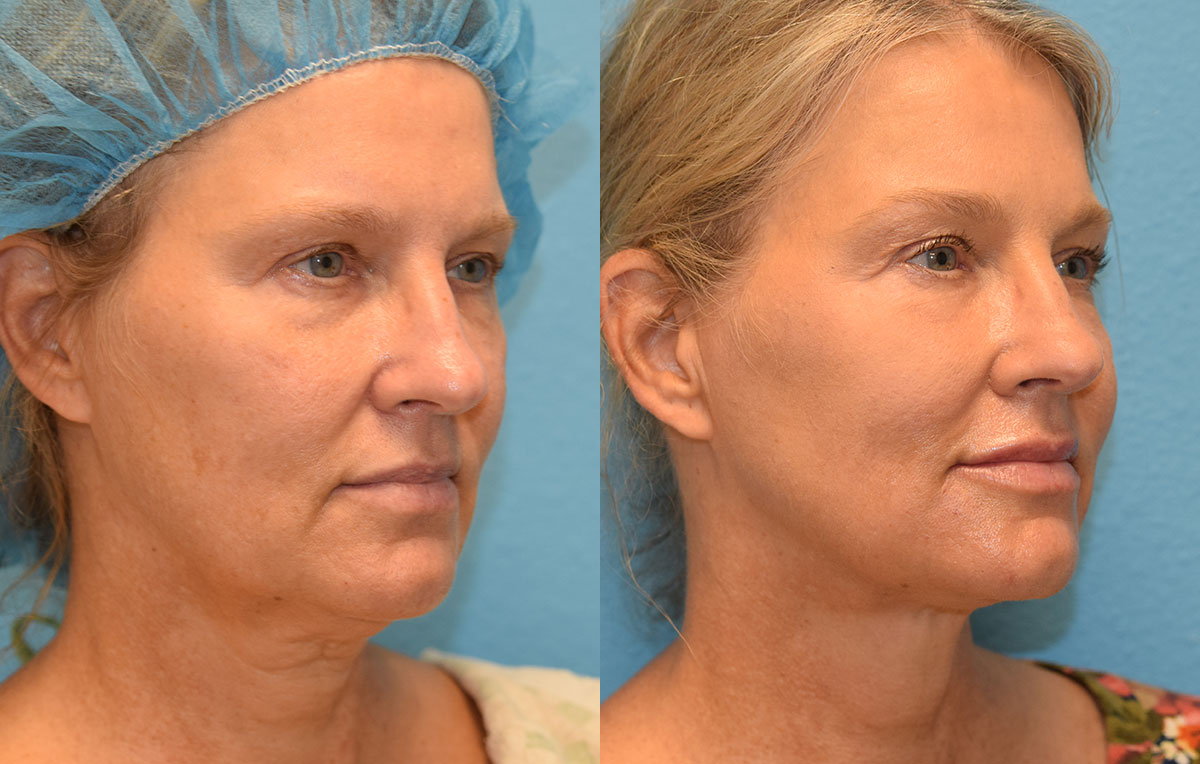 Non-surgical lower blepharoplasty and mini facelift with accutite and Facetite. Minimally invasive procedure by Dr. Maningas in Joplin, MO