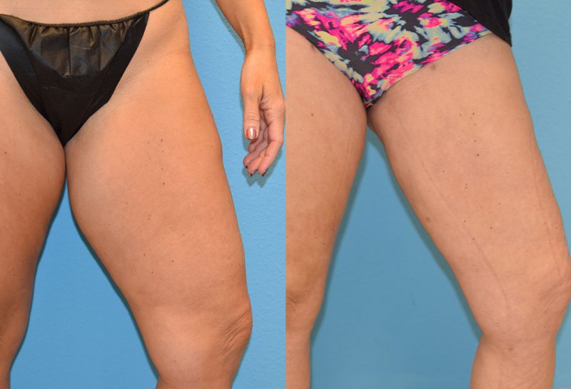 Bodytite, skin tightening and fat reduction, to the thighs by Dr. Maningas in Joplin, MO