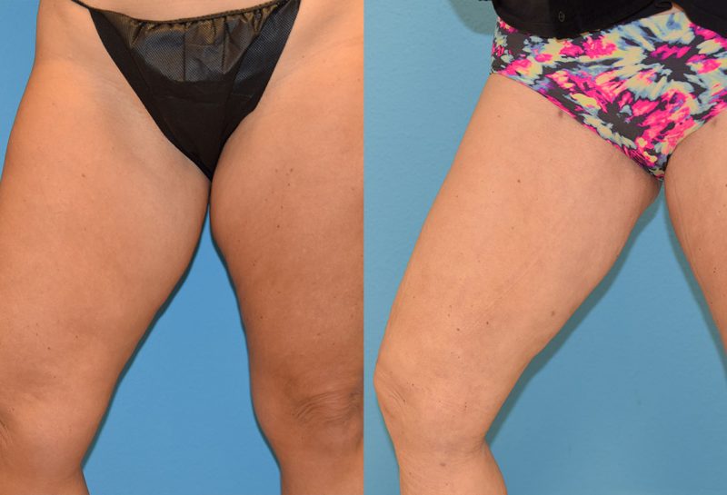 Bodytite, skin tightening and fat reduction, to the thighs by Dr. Maningas in Joplin, MO