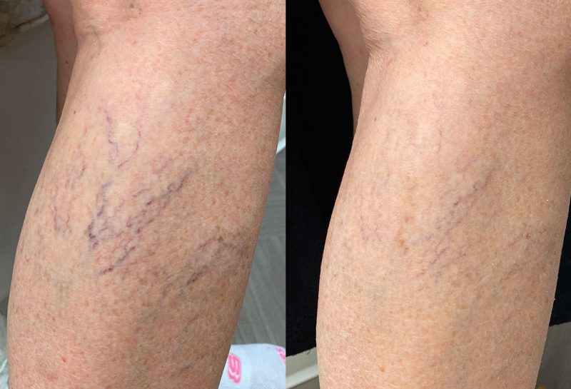 Sclerotherapy for spider veins at Maningas Cosmetic Surgery in Joplin, MO, Northwest Arkansas, Southeast Kansas, Northeast Oklahoma.