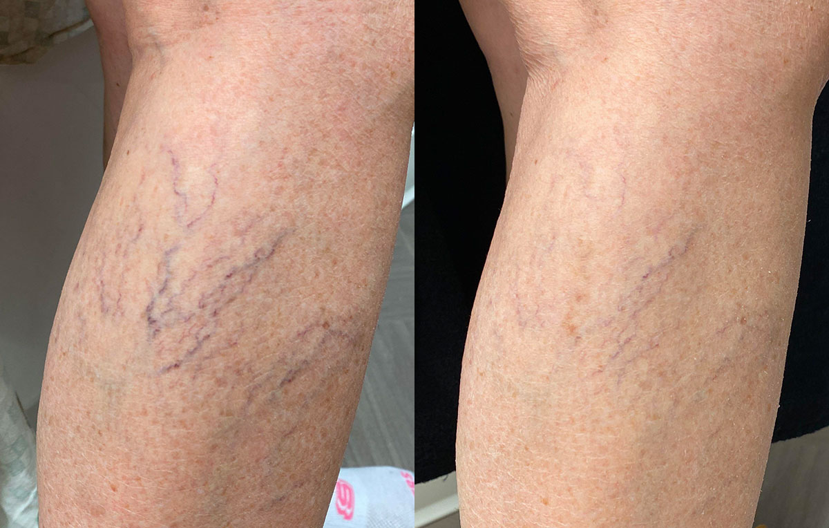 Sclerotherapy for spider veins at Maningas Cosmetic Surgery in Joplin, MO, Northwest Arkansas, Southeast Kansas, Northeast Oklahoma.