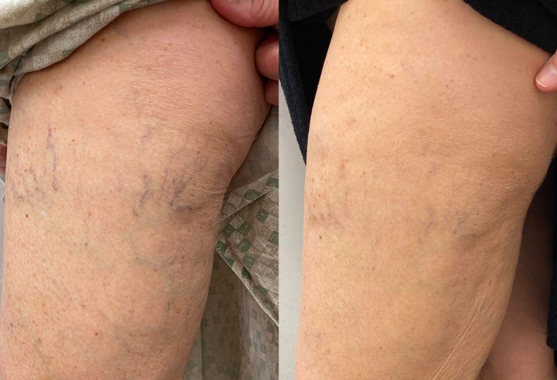 Sclerotherapy for spider veins at Maningas Cosmetic Surgery in Joplin, MO, Northwest Arkansas, Southeast Kansas, Northeast Oklahoma.