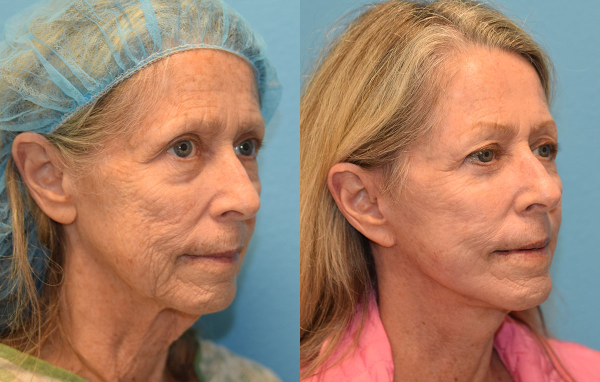 Facelift, Eyelid Surgery and CO2 laser results at Maningas Cosmetic Surgery in Joplin, MO and Northwest Arkansas