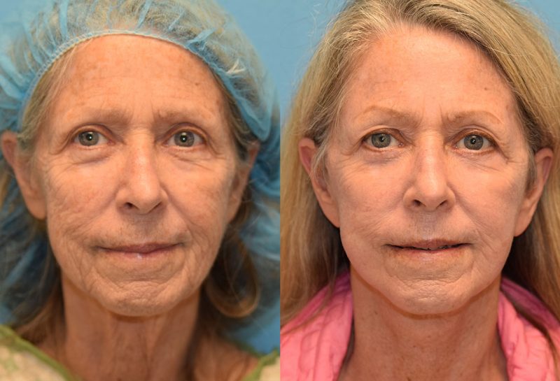 Facelift, Eyelid Surgery and CO2 laser results at Maningas Cosmetic Surgery in Joplin, MO and Northwest Arkansas