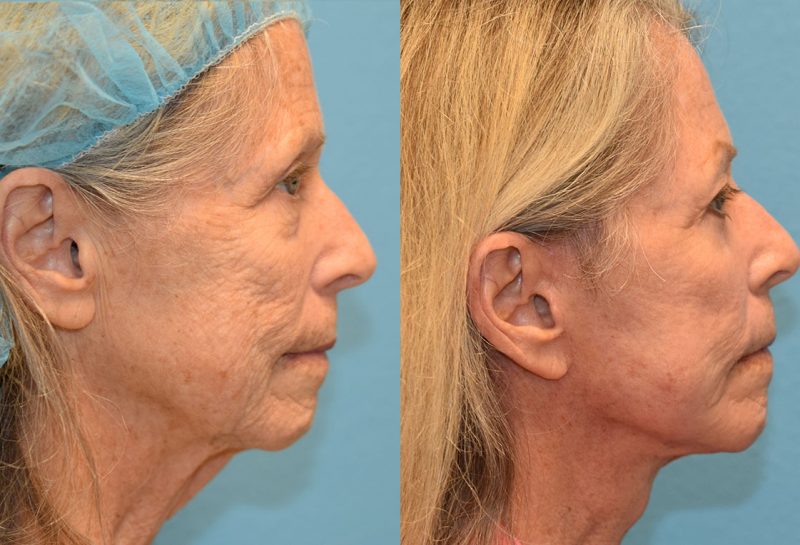 Facelift, Eyelid Surgery and CO2 laser results at Maningas Cosmetic Surgery in Joplin, MO and Northwest Arkansas