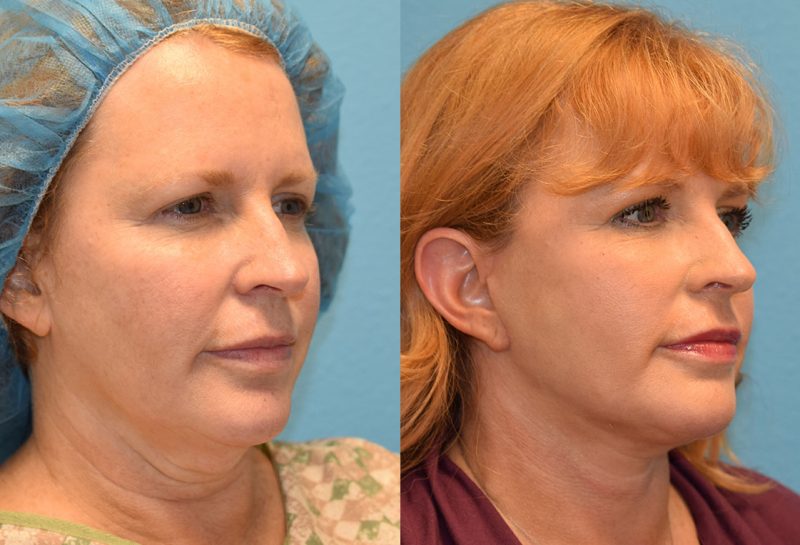 Facelift results at Maningas Cosmetic Surgery in Joplin, MO and Northwest Arkansas