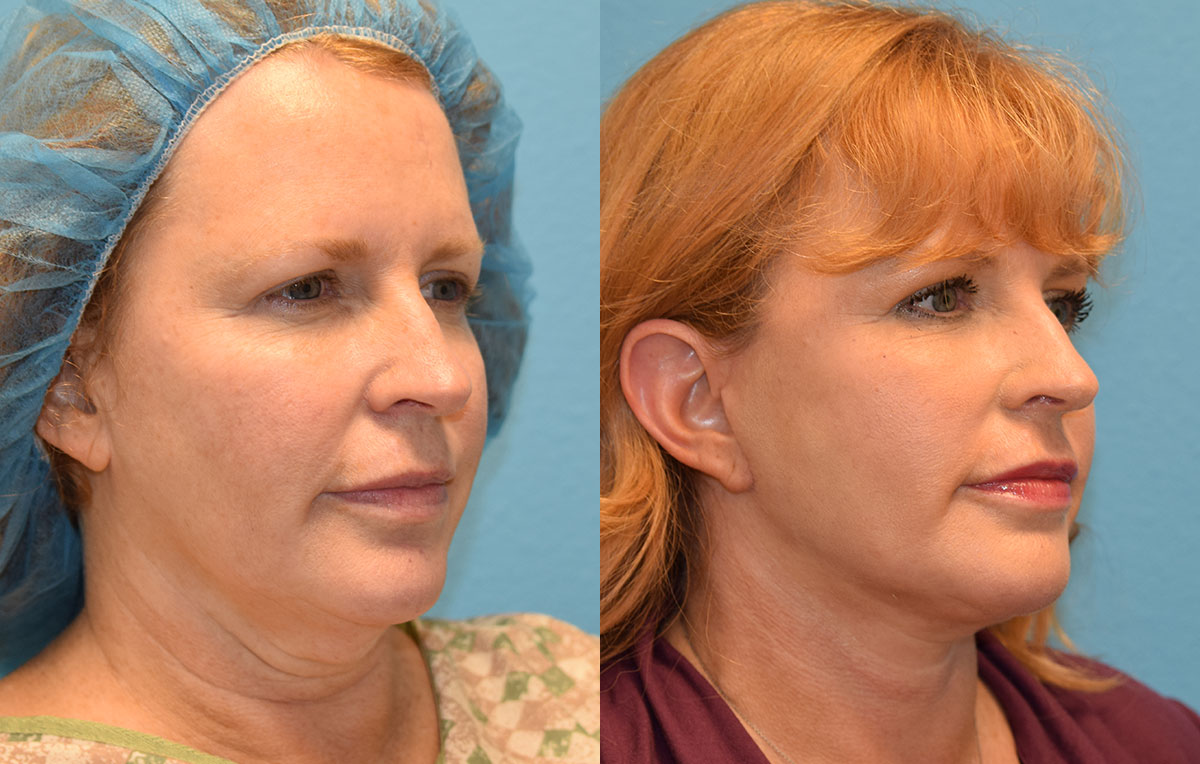 Facelift results at Maningas Cosmetic Surgery in Joplin, MO and Northwest Arkansas