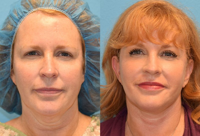 Facelift results at Maningas Cosmetic Surgery in Joplin, MO and Northwest Arkansas