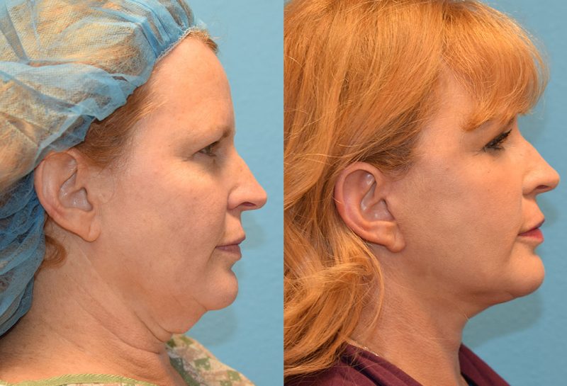 Facelift results at Maningas Cosmetic Surgery in Joplin, MO and Northwest Arkansas