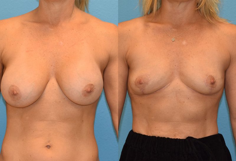 Implant Removal with a Breast Lift by Dr. Maningas at Maningas Cosmetic Surgery in Joplin, MO