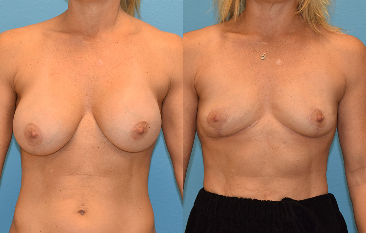 Implant Removal with a Breast Lift by Dr. Maningas at Maningas Cosmetic Surgery in Joplin, MO