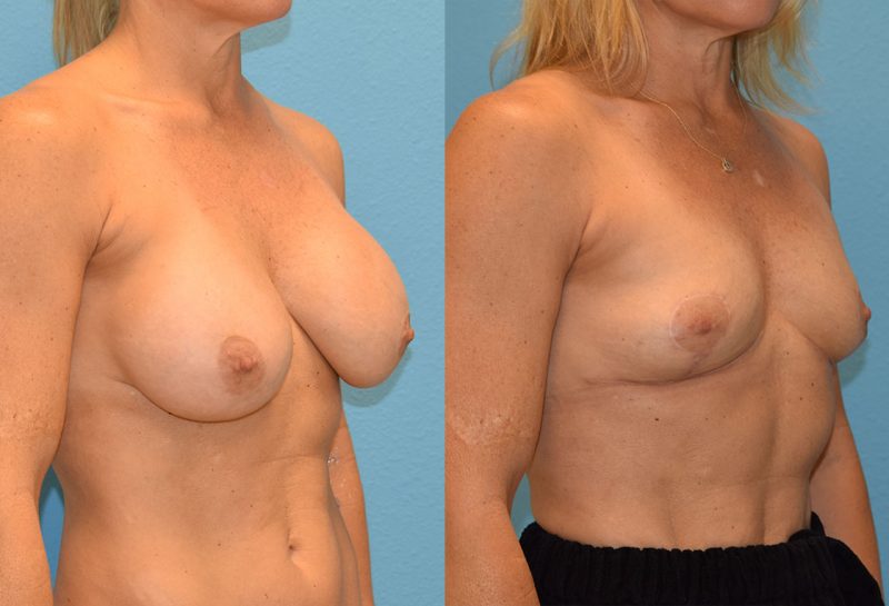 Implant Removal with a Breast Lift by Dr. Maningas at Maningas Cosmetic Surgery in Joplin, MO