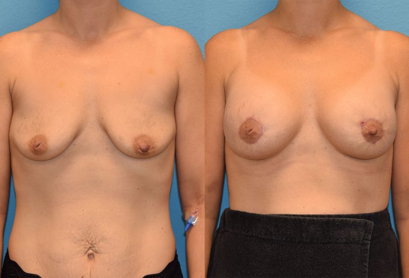 Breast Lift with Implants results by Dr. Maningas as Maningas Cosmetic Surgery