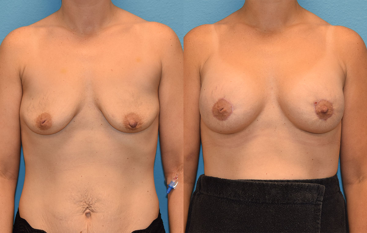 Breast Lift with Implants results by Dr. Maningas as Maningas Cosmetic Surgery