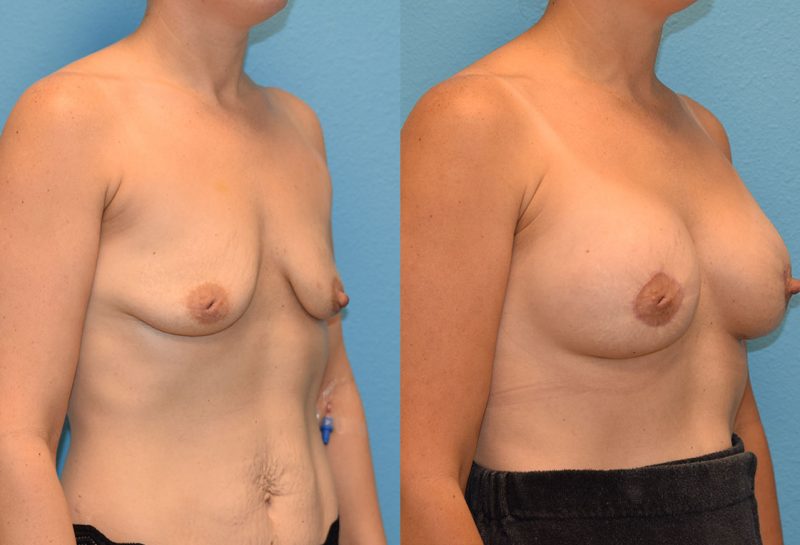 Breast Lift with Implants results by Dr. Maningas as Maningas Cosmetic Surgery