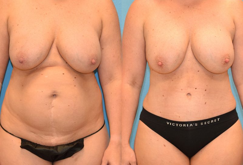 Tummy tuck results by Dr. Maningas at Maningas Cosmetic Surgery in Joplin, MO