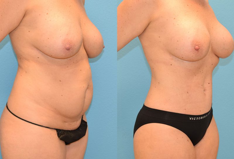 Tummy tuck results by Dr. Maningas at Maningas Cosmetic Surgery in Joplin, MO