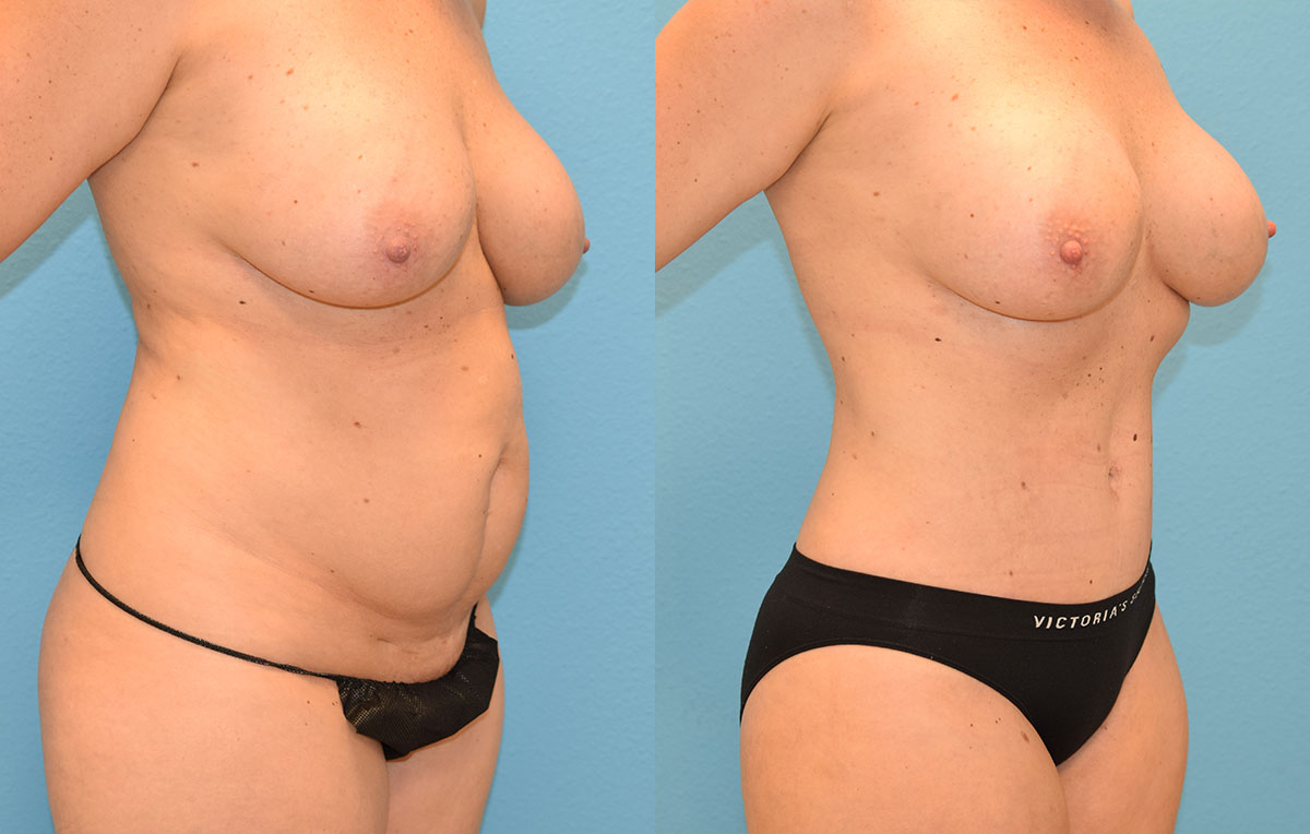 Tummy tuck results by Dr. Maningas at Maningas Cosmetic Surgery in Joplin, MO