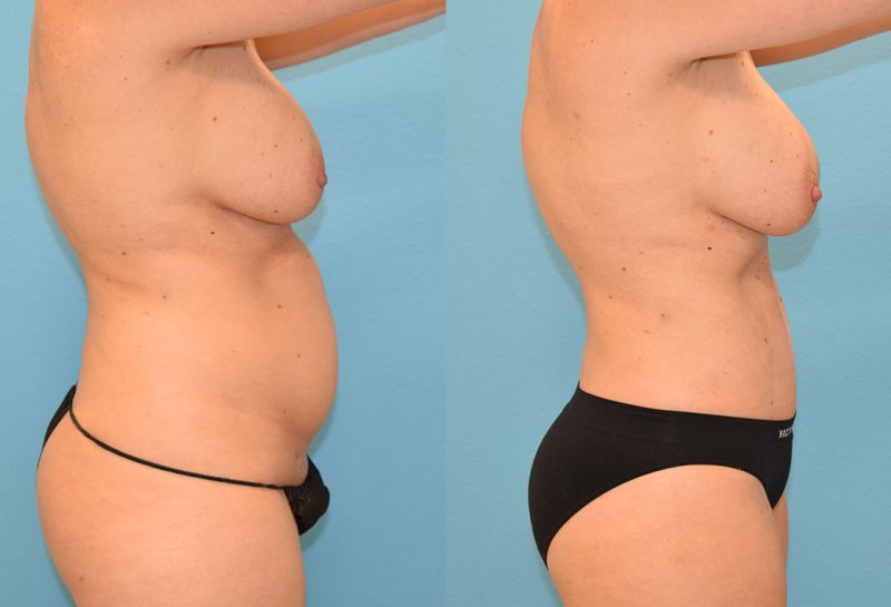 Tummy tuck results by Dr. Maningas at Maningas Cosmetic Surgery in Joplin, MO