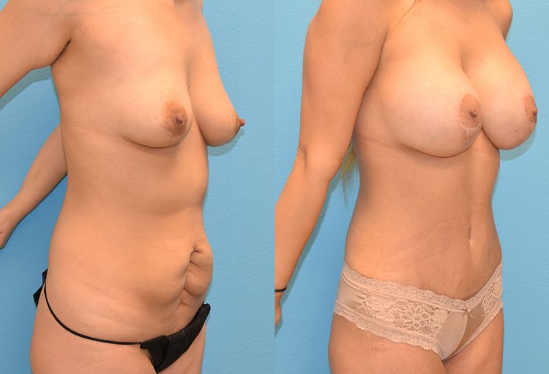 Mommy Makeover, tummy tuck and a breast augmentation with a lift, results by Dr. Maningas at Maningas Cosmetic Surgery in Joplin, MO