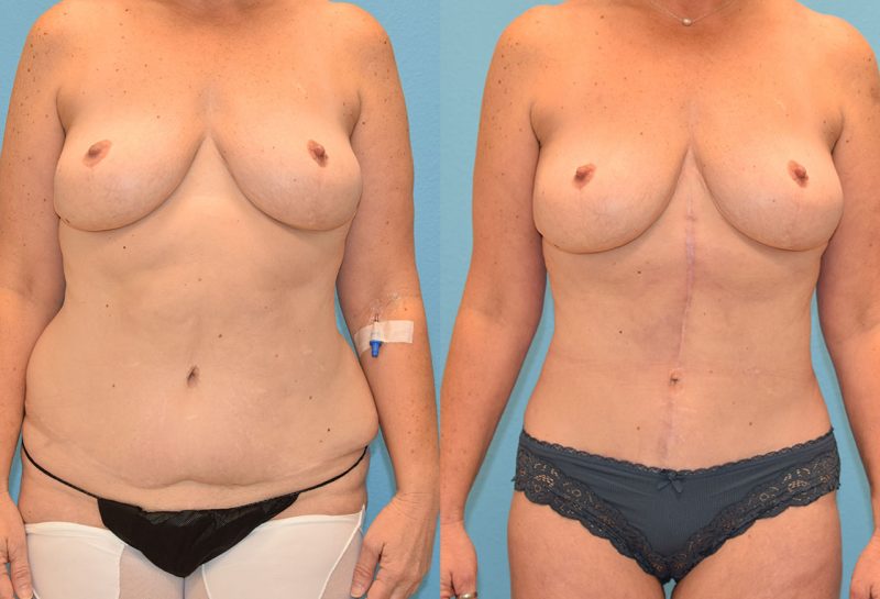 Tummy tuck results by Dr. Maningas at Maningas Cosmetic Surgery in Joplin, MO