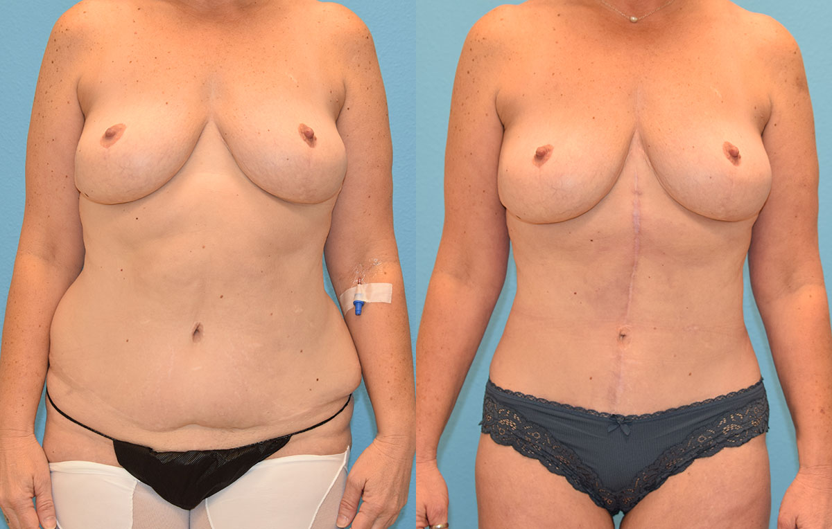 Tummy tuck results by Dr. Maningas at Maningas Cosmetic Surgery in Joplin, MO