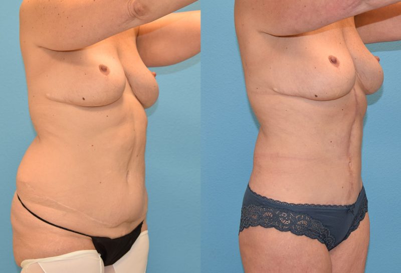 Tummy tuck results by Dr. Maningas at Maningas Cosmetic Surgery in Joplin, MO