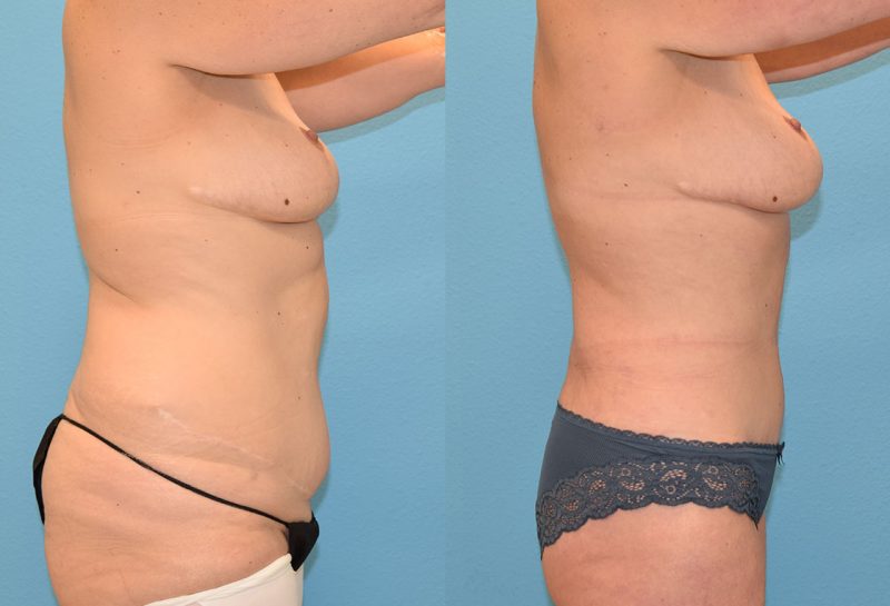 Tummy tuck results by Dr. Maningas at Maningas Cosmetic Surgery in Joplin, MO