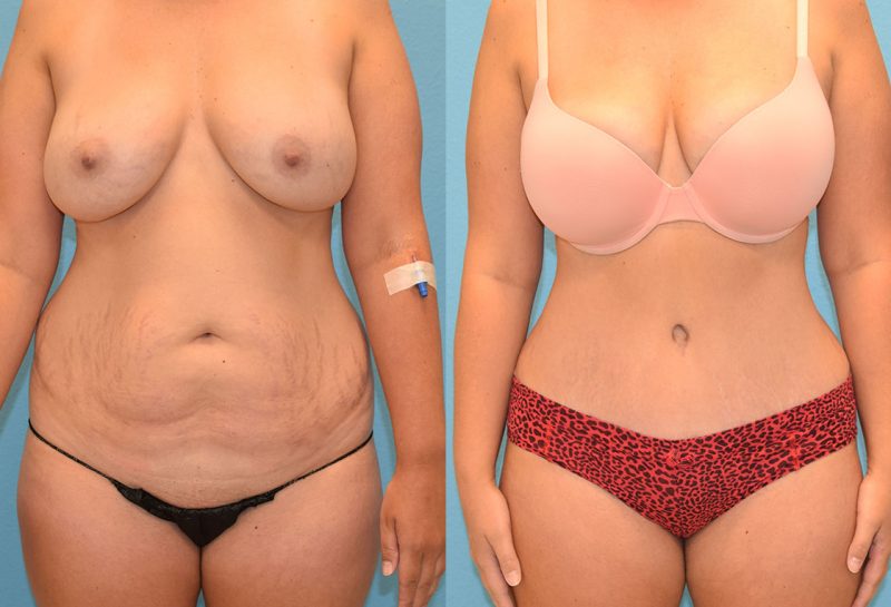 Tummy tuck results by Dr. Maningas at Maningas Cosmetic Surgery in Joplin, MO